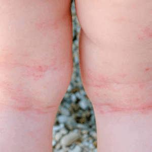 Mycoplasma & Ureaplasma