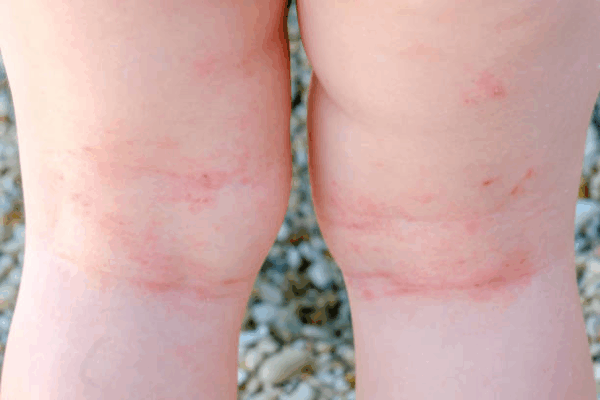 Mycoplasma & Ureaplasma