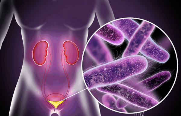 Bacterial vaginosis - Image 2