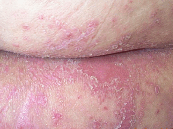 Bacterial vaginosis - Image 3